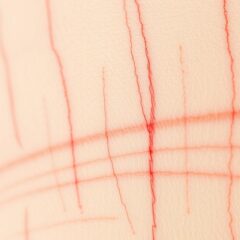 Czerwone kreski na ciele: objawy, przyczyny i leczenie dermografizmu